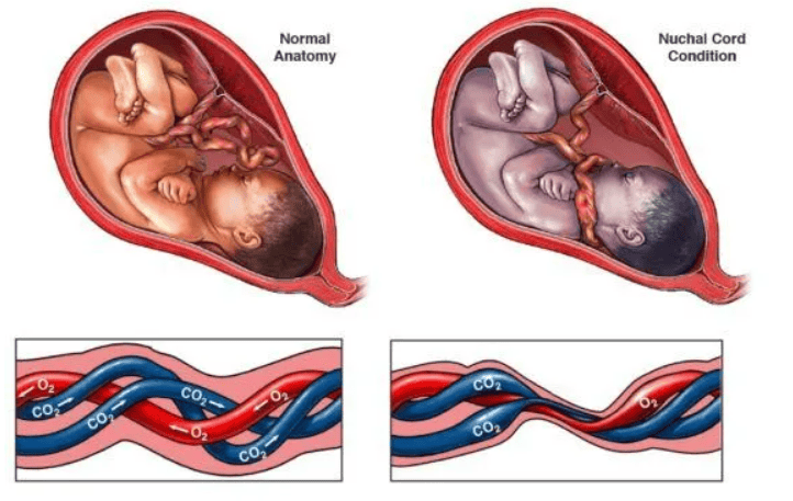 Umbilical Cord Affect Pregnancy and Delivery